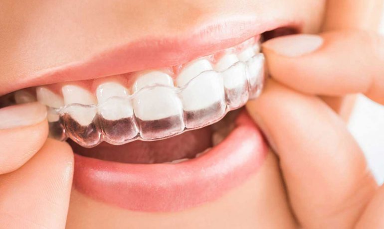 Invisalign y la importancia del tratamiento de ortodoncia con un profesional